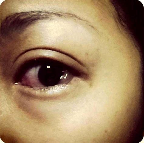 Chemosis Images » Eyelid Surgery: Cost, Photos, Rewiews, Q&A