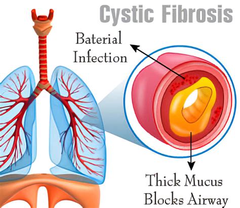 What is Cystic Fibrosis? - Physiologic Instruments