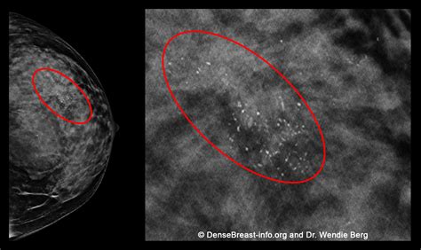 If mammograms miss some cancers in dense breasts, should I still have a ...