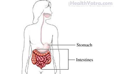 Intestinal Pseudo-obstruction Definition, Causes, Symptoms ...