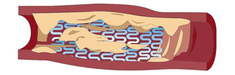 Understanding In-Stent Restenosis (ISR) - Boston Scientific