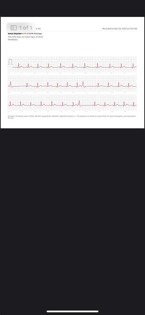 Should I be worried about these skipped heart beats? : r/medical