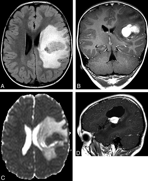 Pleomorphic Xanthoastrocytoma of Childhood: MR Imaging and Diffusion MR ...