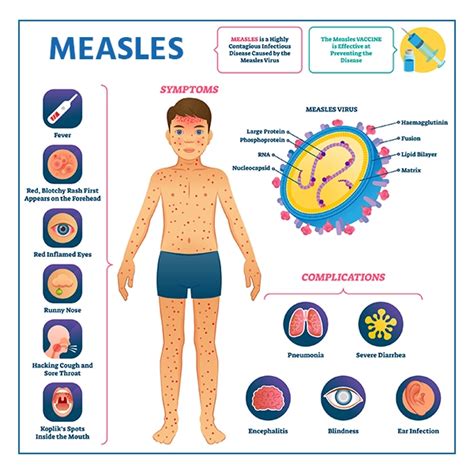 Measles: Symptoms, Causes, Treatment and Prevention