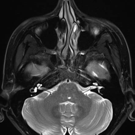 Abducens Nerve