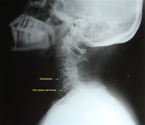 Cervical Spondylosis X Ray / Treatment for Cervical Spondylosis ...