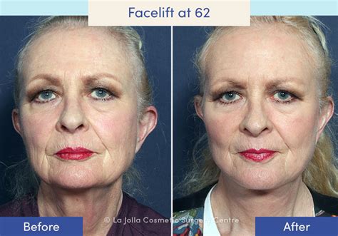 Facelift Before & After Photos: What a Facelift Looks Like at 40, 50 ...