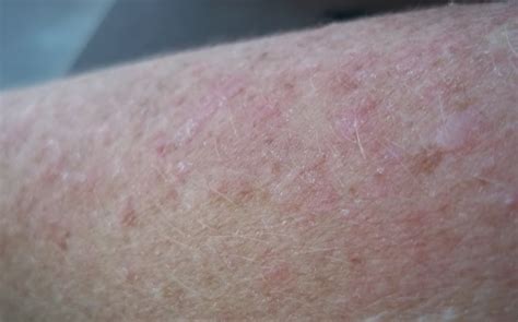 lupus rash pictures - pictures, photos