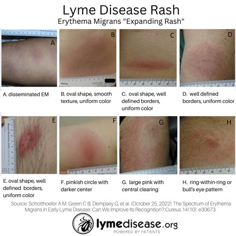 A Lyme rash doesn't always look like a bull's-eye target | LymeDisease.org