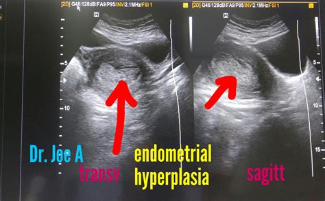 Ultrasound imaging: Cystic-endometrial-hyperplasia-3D ultrasound