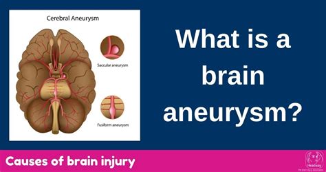 How To Detect A Brain Aneurysm - Sellsense23