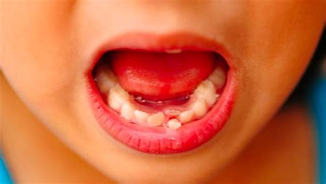 How To Pull A Tooth At Home | Knoxville Family Dentistry