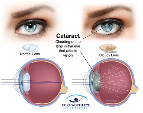 Replacement lenses after cataract surgery