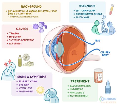 Iridocyclitis: What Is It, Causes, Diagnosis, Treatment, and More | Osmosis