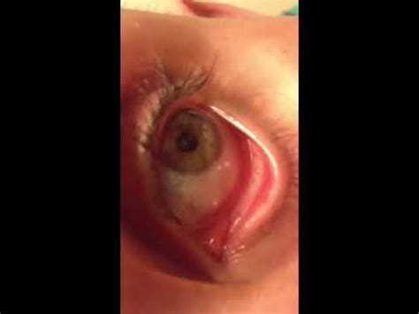 Hookworm in eye - YouTube