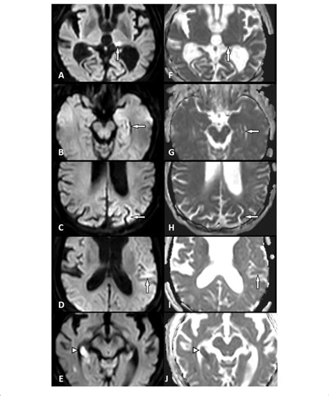 | Diffusion restriction in status epilepticus (SE) and acute ischemic ...