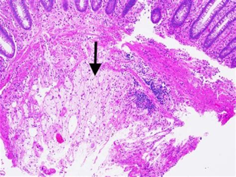 Dense collection of foamy macrophages (arrow) within submucosa, biopsy ...