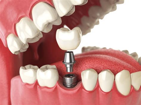 Everything You Need To Know About Dental Implants - Regency Square Dental