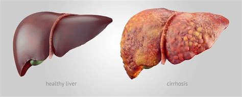 Hepatocellular Carcinoma: Risks, Symptoms & Treatments