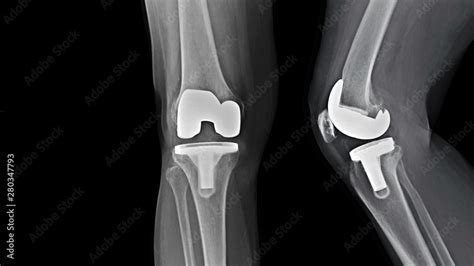 Film X-ray knee radiograph showing degenerative osteoarthritis (OA knee ...