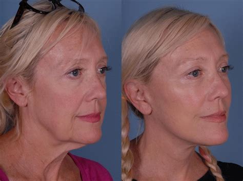 Is a Mini Facelift the Right Procedure for Me? | Get Fit Owasso