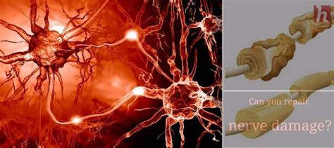 Can you repair nerve damage | Nerve damage treatment, Nerve damage, Nerve