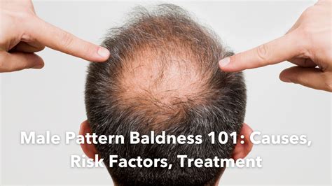 Male Pattern Baldness 101: Causes, Risk Factors, Treatment - Homage ...