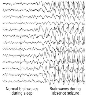 Electroencephalogram (EEG) - Harvard Health