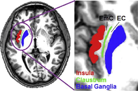 e Axial MRI scan highlighting the region of the extreme capsule. Red ¼ ...