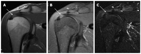 MRI Musculo-Skeletal Section: Supra spinatous tendon tendinosis.