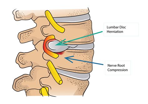 Lumbar Disc Herniation and Sciatica | Dr Yu Chao Lee