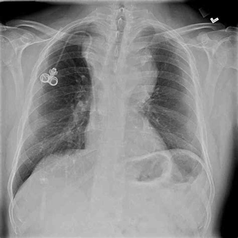 [Figure, Periapical (PA) Chest Radiograph, Anterior...] - StatPearls ...