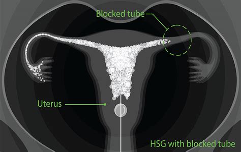 HSG Test / Fallopian Tube Testing - KL Fertility Centre