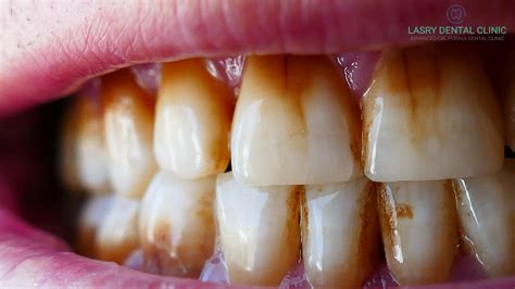 How To Get Rid of Teeth Discoloration: At home and Professional Options