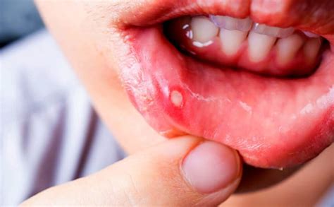 Know about mouth ulcer – its causes and remedies | Bigumbrella