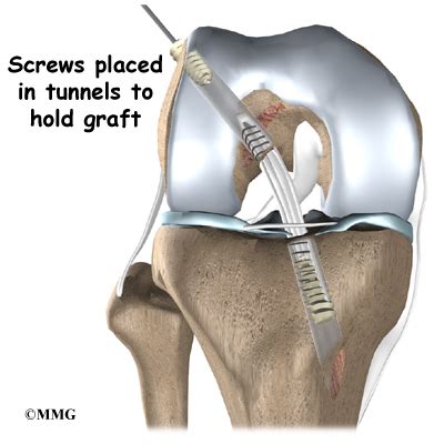 ACL Hamstring Tendon Graft Reconstruction - eOrthopod.com