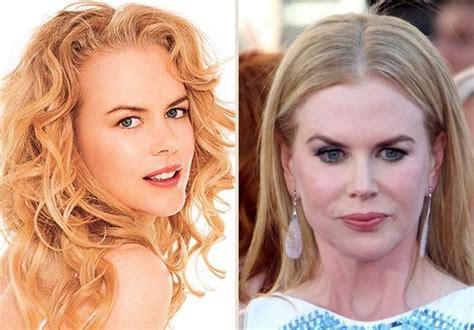 Nicole Kidman Before and after plastic surgery – Celebrity plastic ...