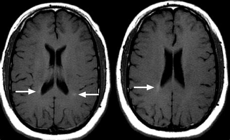 Multiple Sclerosis Research: Problems with assessing new lesions on MRI