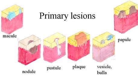 Primary lesions