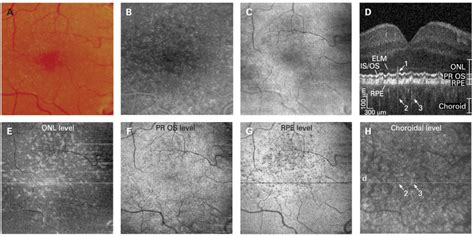 Basal laminar drusen. (A) Colour fundus photograph. (B) Fluorescein ...