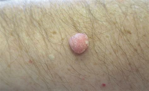 What Is This Slow-Growing Asymptomatic Nodule on a Man’s Arm ...