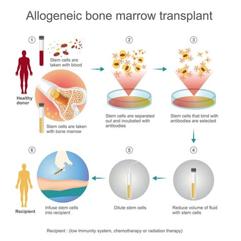 Stem Cell Transplants: What To Know About This Life-Saving Procedure