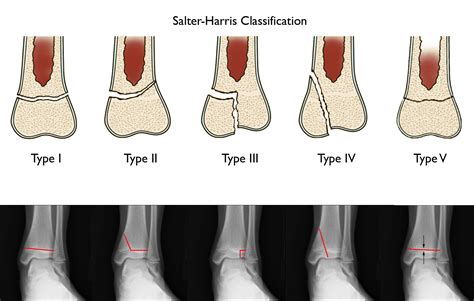 Ankle Fractures In Children - OrthoInfo - AAOS