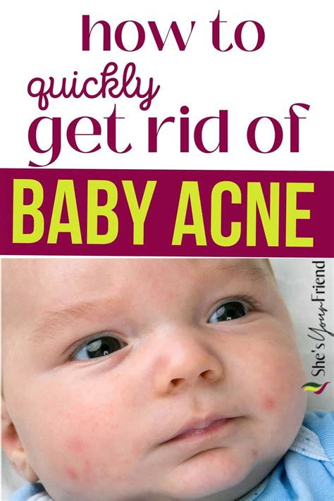 How to get rid of baby acne - She's Your Friend