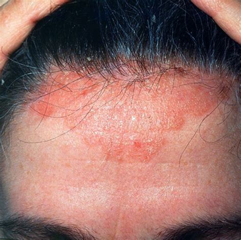 scabies on the scalp - pictures, photos