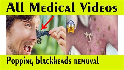 Pimple Popping Videos 2024 Blackheads Removal Youtube - Lina Shelby