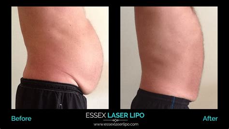 Laser Lipo Before And After | CHC Aesthetics | Essex Laser Lipo