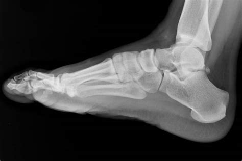 Outdoor Hazards: Sprained Ankle | GearJunkie