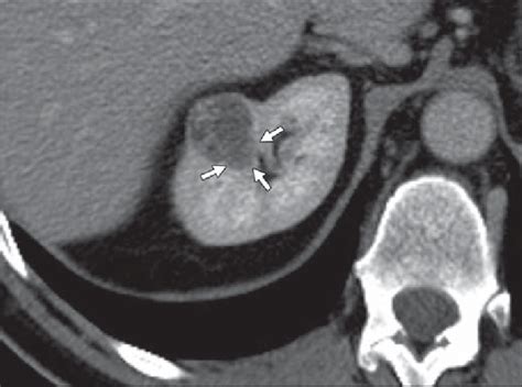 year-old woman with renal cell carcinoma. CT scan shows angular ...