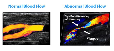 Carotid Doppler Ultrasound Chart